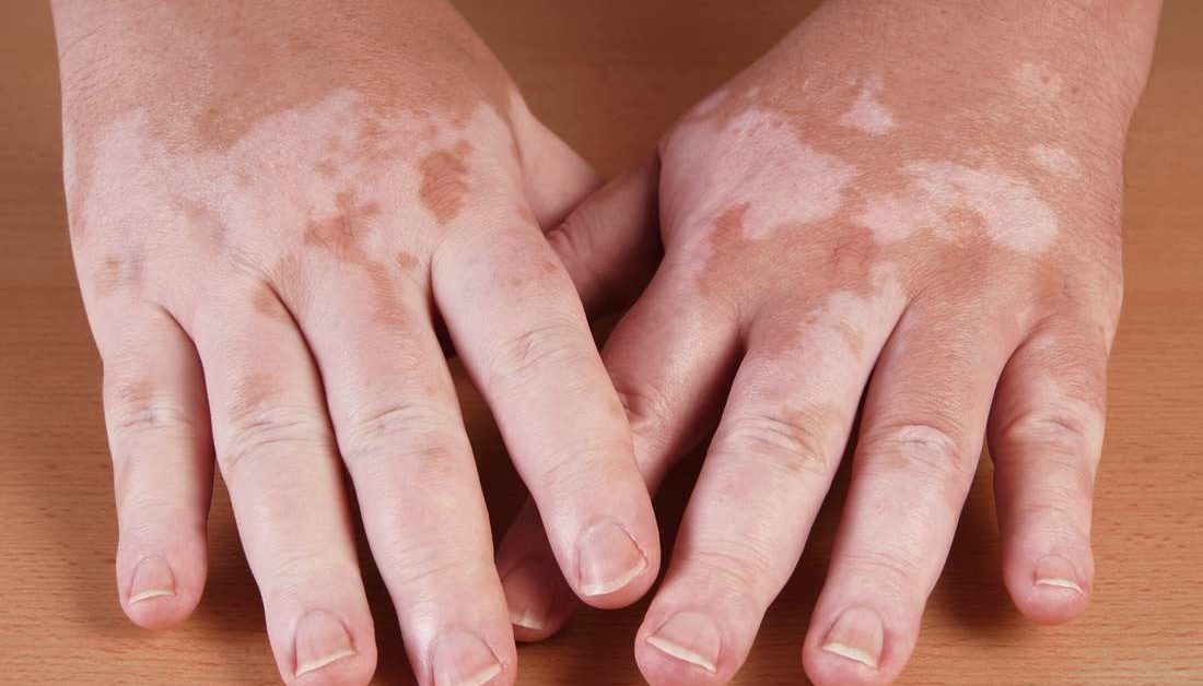 Bu sistematik derleme ve meta-analizin bulguları, UV fototerapisinin önemli bir cilt kanseri riski olmaksızın vitiligo için güvenli bir tedavi olduğunu göstermektedir.